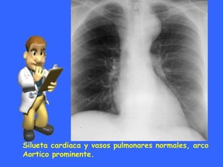 Silueta cardiaca y vasos pulmonares normales, arco
Aortico prominente.
 