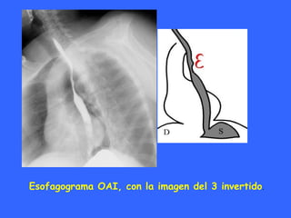 Esofagograma OAI, con la imagen del 3 invertido.
 