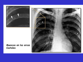 Muescas en los arcos
Costales
 