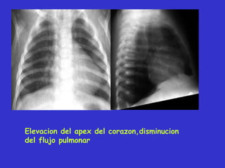 Elevacion del apex del corazon,disminucion
del flujo pulmonar
 