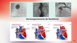 Conservative Rashkind Bas Comprehensive Overview of Cyanotic Congenital Heart Diseases: Tetralogy ...