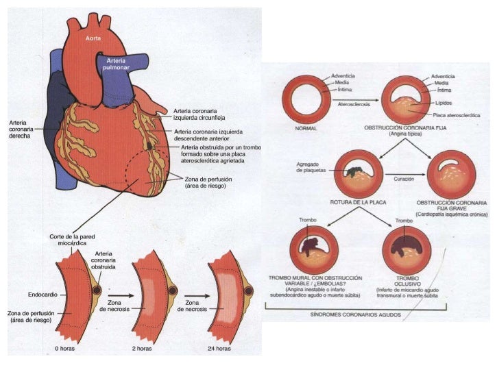 A Fisiopatologia Da Cardiopatia Isquêmica Envolve Especificamente Dois Processos