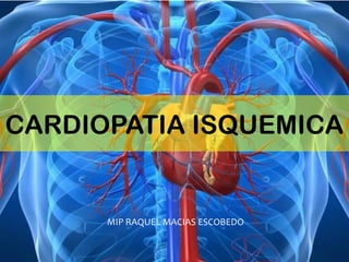 CARDIOPATIA ISQUEMICA
MIP RAQUEL MACIAS ESCOBEDO
 