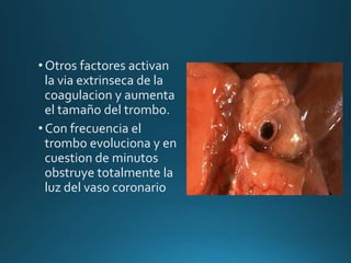 • Otros factores activan
la via extrinseca de la
coagulacion y aumenta
el tamaño del trombo.
• Con frecuencia el
trombo evoluciona y en
cuestion de minutos
obstruye totalmente la
luz del vaso coronario
 