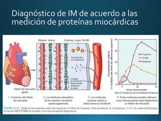 Diagnóstico de IM de acuerdo a las
medición de proteínas miocárdicas
 