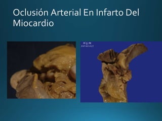 Oclusión Arterial En Infarto Del
Miocardio
 