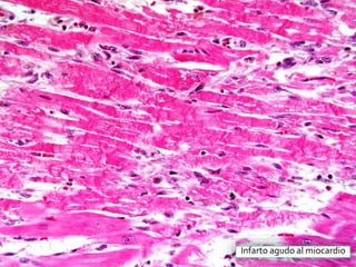 Infarto agudo al miocardio
 