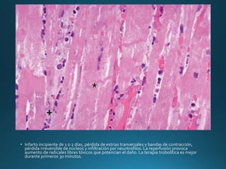 • Infarto incipiente de 1 o 2 días, pérdida de estrias tranversales y bandas de contracción,
pérdida irreversible de núcleos y infiltración por neuntrofilos. La reperfusión provoca
aumento de radicales libres tóxicos que potencian el daño. La terapia trobolítica es mejor
durante primeros 30 minutos.
 