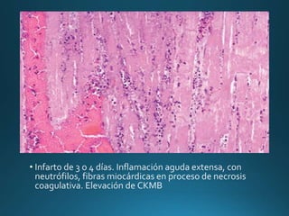 • Infarto de 3 o 4 días. Inflamación aguda extensa, con
neutrófilos, fibras miocárdicas en proceso de necrosis
coagulativa. Elevación de CKMB
 