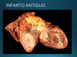 INFARTO ANTIGUO
 