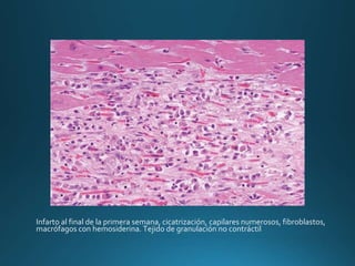 Infarto al final de la primera semana, cicatrización, capilares numerosos, fibroblastos,
macrófagos con hemosiderina. Tejido de granulación no contráctil
 