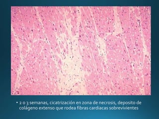 • 2 o 3 semanas, cicatrización en zona de necrosis, deposito de
colágeno extenso que rodea fibras cardiacas sobrevivientes
 