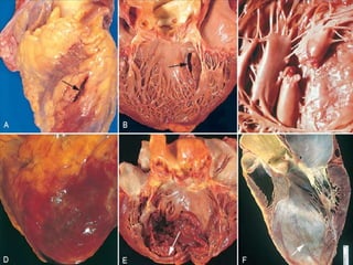 CARDIOPATÍA ISQUÉMICA2.pptx