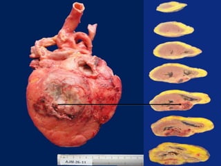 CARDIOPATÍA ISQUÉMICA2.pptx