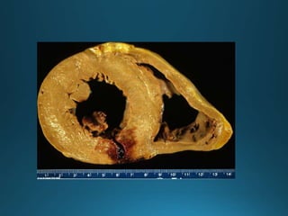 CARDIOPATÍA ISQUÉMICA2.pptx