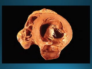CARDIOPATÍA ISQUÉMICA2.pptx