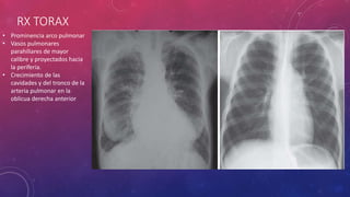 RX TORAX
• Prominencia arco pulmonar
• Vasos pulmonares
parahiliares de mayor
calibre y proyectados hacia
la periferia.
• Crecimiento de las
cavidades y del tronco de la
arteria pulmonar en la
oblicua derecha anterior
 