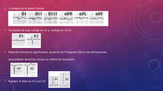 • < voltajes en el plano frontal.
• Complejo de bajo voltaje en V1 y >voltaje en v2 v3
• Rotación horaria es significativa, ausencia de R (registro QS) en las derivaciones
precordiales derechas simula un infarto de miocardio.
• Pueden: R altas en V1 y en V2
 