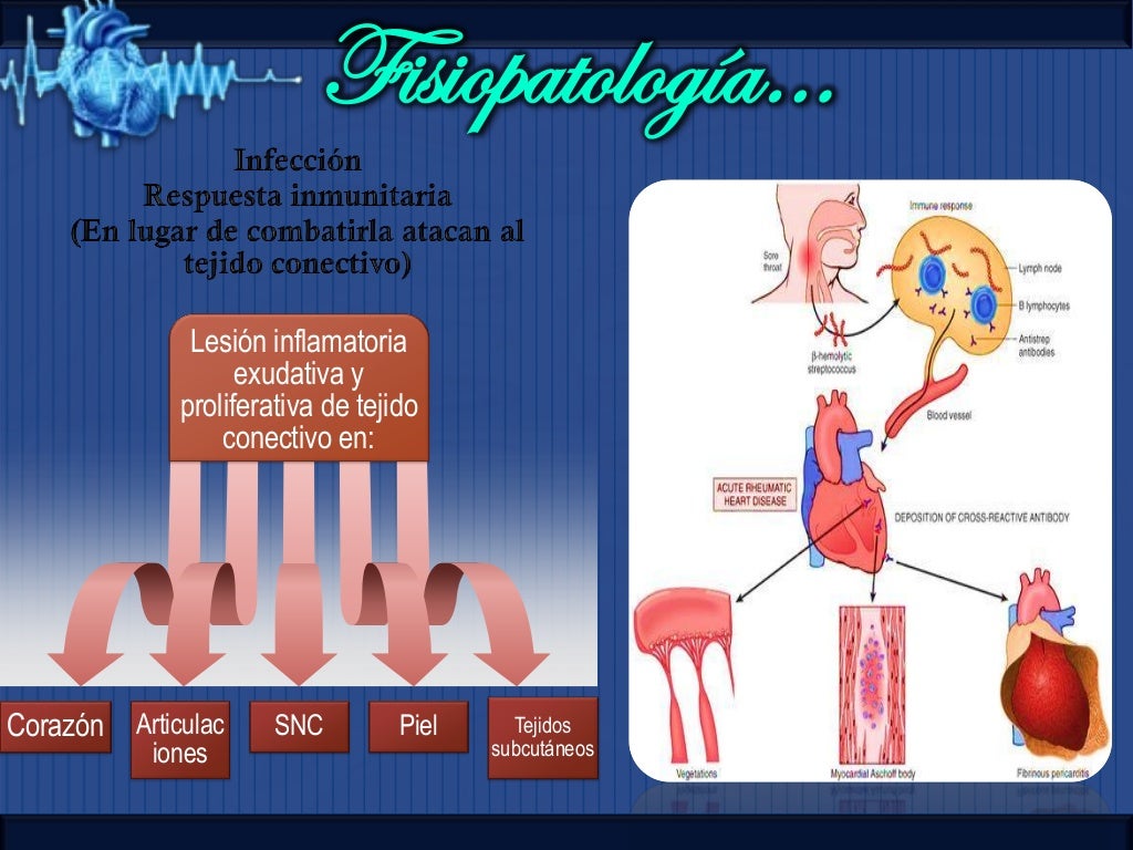 Cardiopatia reumatica