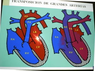 Cardiopatias