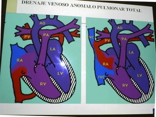 Cardiopatias