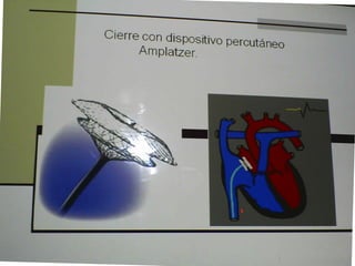 Cardiopatias