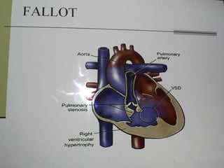 Cardiopatias