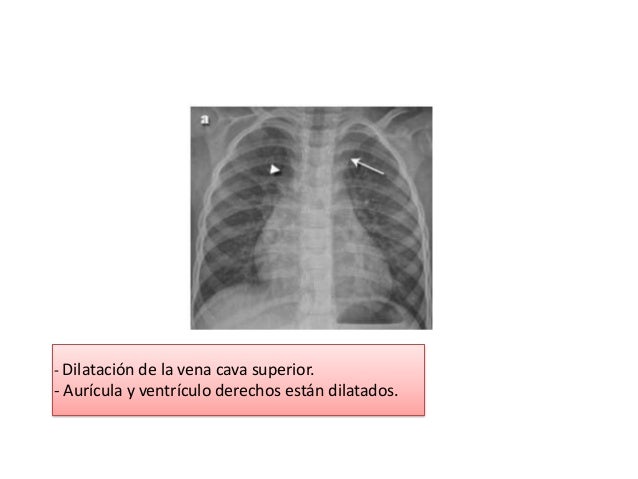 dilatacion de auricula izquierda dilatacion de auricula izquierda
