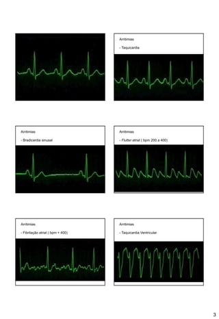 3
Arritimias
- Taquicardia
Arritimias
- Bradicardia sinusal
Arritimias
- Flutter atrial ( bpm 200 a 400)
Arritimias
- Fibrilação atrial ( bpm + 400)
Arritimias
- Taquicardia Ventricular
 