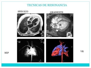Cardiopatias acianoticas md6 1 | PPT