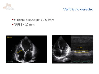 Ventrículo derecho
S’ lateral tricúspide < 9.5 cm/s
TAPSE < 17 mm
41 mm
11 mm
 