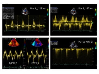 Dur Ami 123 ms Dur Ar 160 ms
PSP 50 mmHg
E/E’12,5 E/E’ 7,7
 