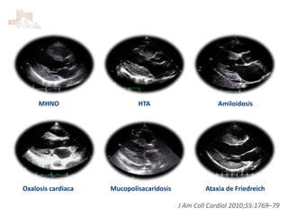 MHNO HTA Amiloidosis
J Am Coll Cardiol 2010;55:1769–79
MucopolisacaridosisOxalosis cardiaca Ataxia de Friedreich
 