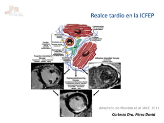 Realce tardío en la ICFEP
Cortesía Dra. Pérez David
Adaptado de Mewton et al JACC 2011
 