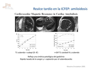 T1 subendo < subepi (0- 8’) <<Dif T1 cavidad VI y subendo
Refleja una cinética patológica del gadolinio
Rápido lavado de la sangre y > captación por el subendocardio
Maceira Circulation 2005
Realce tardío en la ICFEP: amiloidosis
 