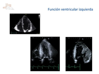 Función ventricular izquierda
 