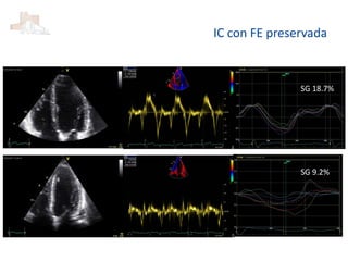 IC con FE preservada
SG 18.7%
SG 9.2%
 