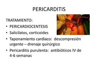 PERICARDITIS
TRATAMIENTO:
• PERICARDIOCENTESIS
• Salicilatos, corticoides
• Taponamiento cardiaco: descompresión
urgente – drenaje quirúrgico
• Pericarditis purulenta: antibióticos IV de
4-6 semanas
 