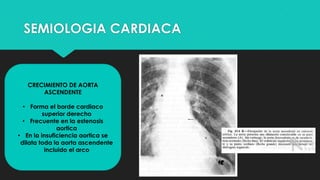 SEMIOLOGIA CARDIACA
CRECIMIENTO DE AORTA
ASCENDENTE
• Forma el borde cardiaco
superior derecho
• Frecuente en la estenosis
aortica
• En la insuficiencia aortica se
dilata toda la aorta ascendente
incluido el arco
 