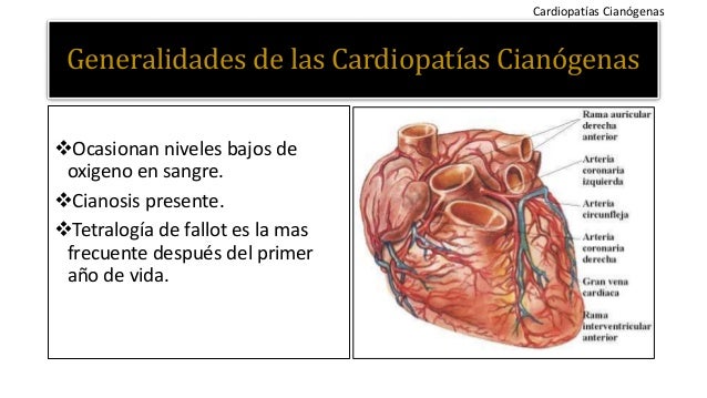 Cardiopatia Congenita Cianogena Mas Frecuente