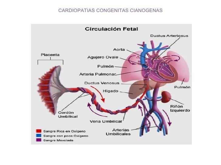 Cardiopatia Congenita Cianogena Mas Frecuente