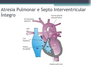 Cardiopatias Cong nitas Cianog nicas PPT