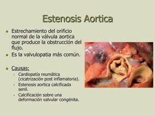 Estenosis Aortica
   Estrechamiento del orificio
    normal de la válvula aortica
    que produce la obstrucción del
    flujo.
   Es la valvulopatia más común.

   Causas:
       Cardiopatía reumática
        (cicatrización post inflamatoria).
       Estenosis aortica calcificada
        senil.
       Calcificación sobre una
        deformación valvular congénita.
 