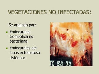 VEGETACIONES NO INFECTADAS:

    Se originan por:
   Endocarditis
    trombótica no
    bacteriana.
   Endocarditis del
    lupus eritematoso
    sistémico.
 