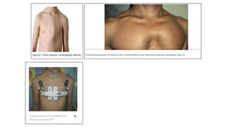CHEST WALL DEFORMITY