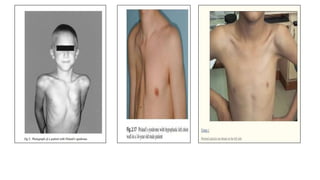 CHEST WALL DEFORMITY
