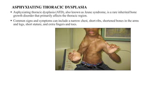 CHEST WALL DEFORMITY