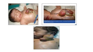 CHEST WALL DEFORMITY