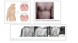 CHEST WALL DEFORMITY