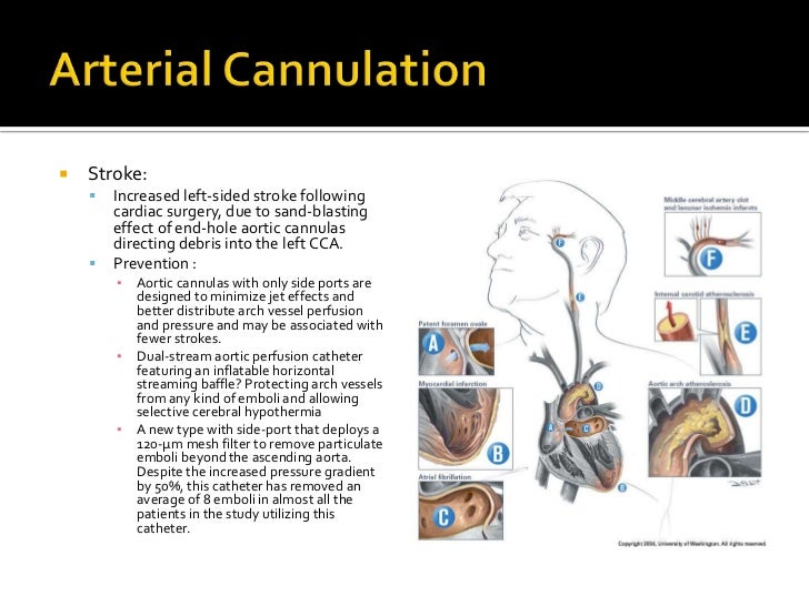 Cardiopulmonary bypass